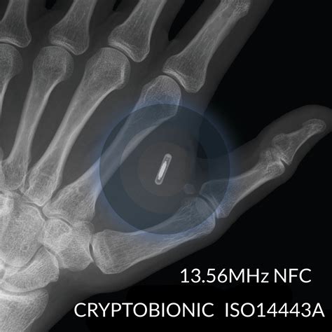 needle that rfid chip|rfid microchip implant.